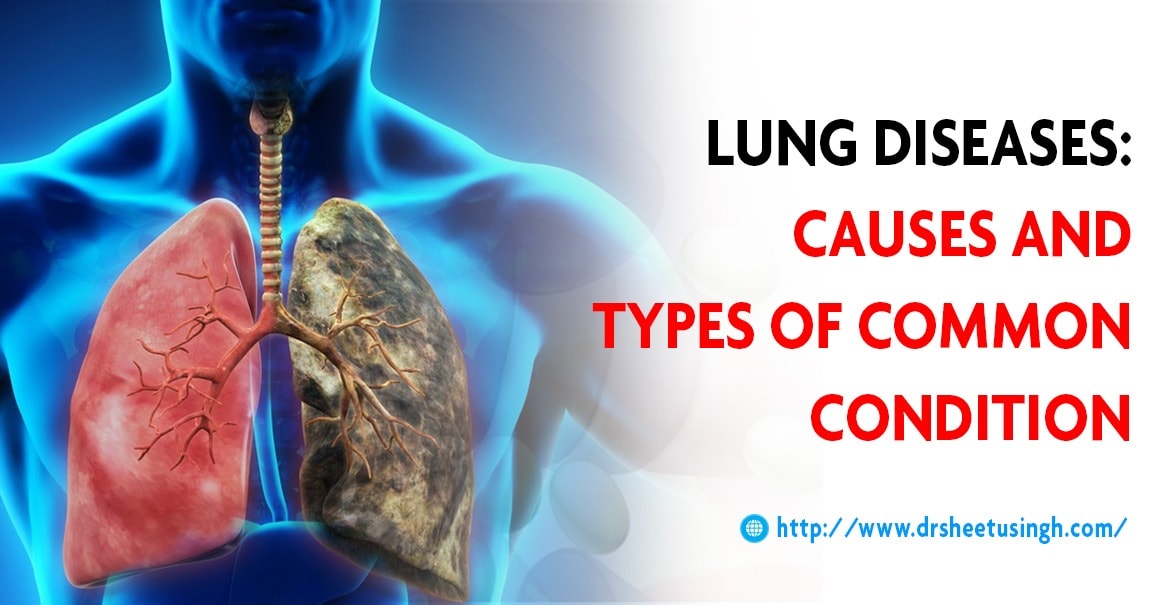 Lung Diseases Types And Causes Breathing Problem Symptoms And Risk