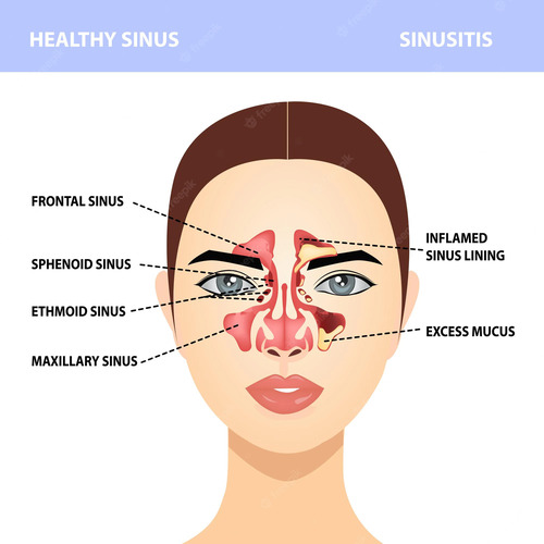 Sinus Infection (Sinusitis)? Types, Causes, Symptom & Treatment