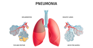 Causes of Hypersensitivity Pneumonitis