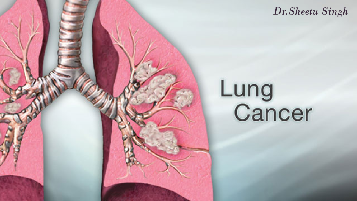 Symptoms-of-Lung-Cancer-1200x677.png